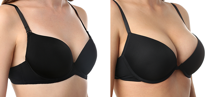  مميزات وعيوب عملية تكبير الثدي