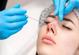 تجميل الأنف بالخيوط: خطوات آمنة للحصول على أنف مثالي بدون جراحة