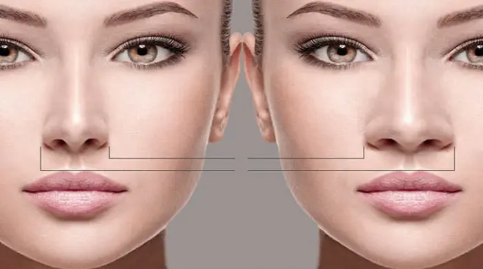 عمليات تجميل الأنف العريض تقنيات متقدمة لضمان أنف مثالي