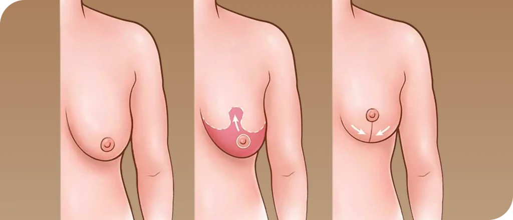 شد الثدي بالخيوط تقنية غير جراحية تمنحك شباباً وتجديداً بدون ألم