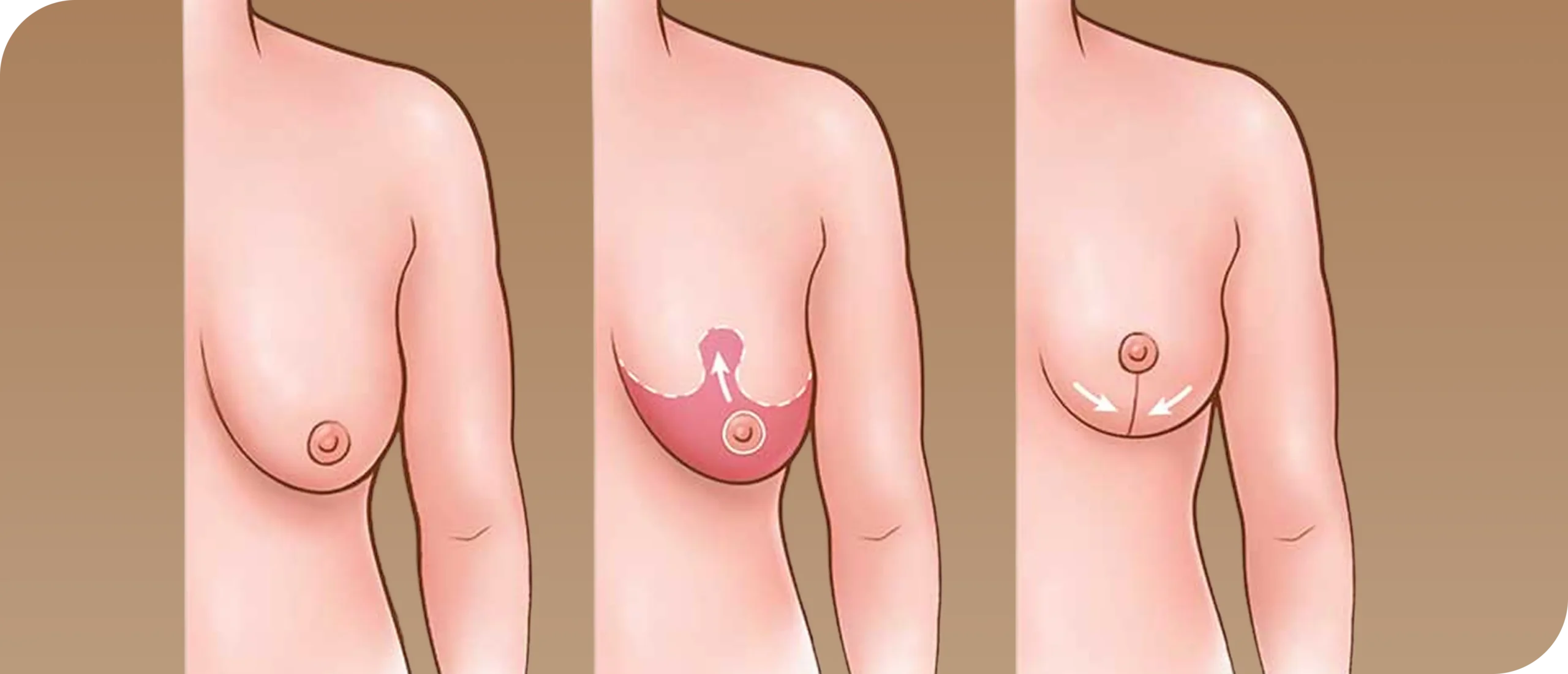 شد الثدي بالخيوط تقنية غير جراحية تمنحك شباباً وتجديداً بدون ألم