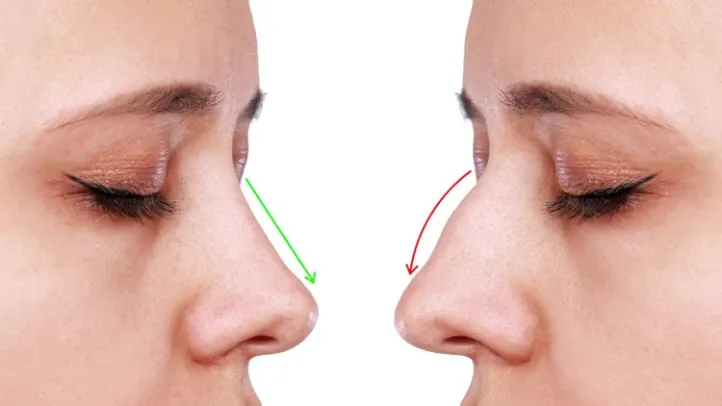 عمليات تصغير الأنف