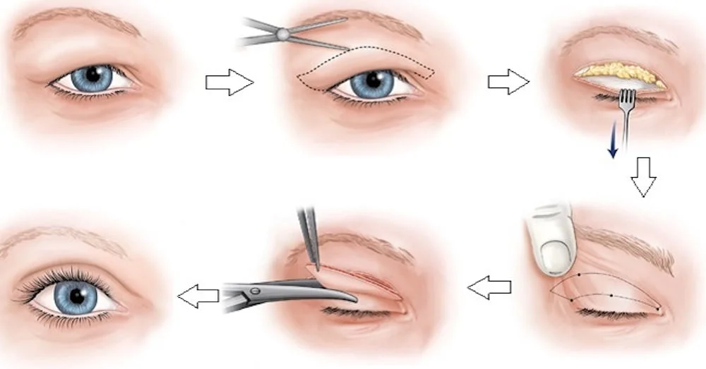 عملية شد الجفون بالصور