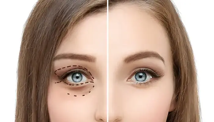 تجميل الجفون