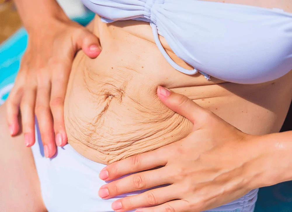 شد ترهلات البطن: استعيدي قوامك المشدود وجمالك الطبيعي