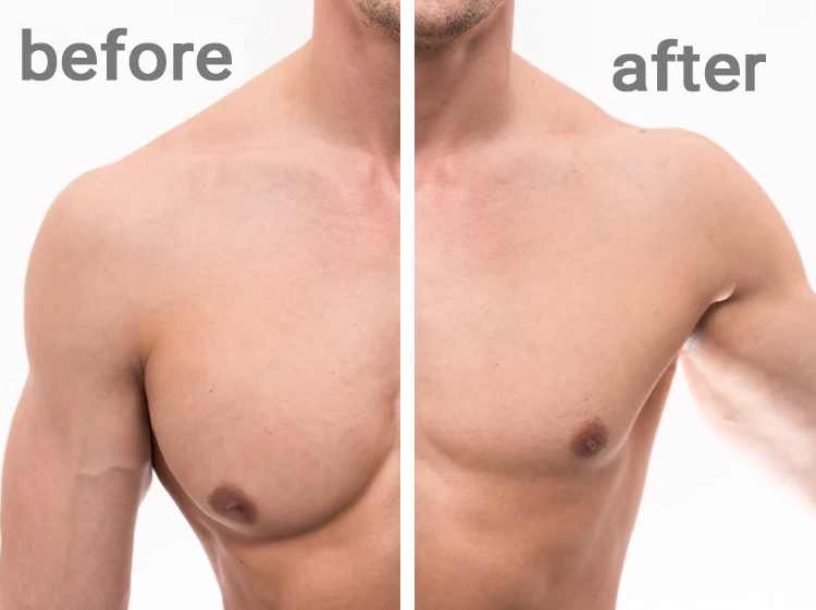 بين التثدي والدهون: الحقيقة المذهلة التي لم يخبرك بها أحد