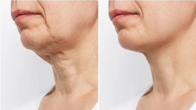 شد ترهلات الرقبة أحدث التقنيات لاستعادة مظهر شبابي مشدود