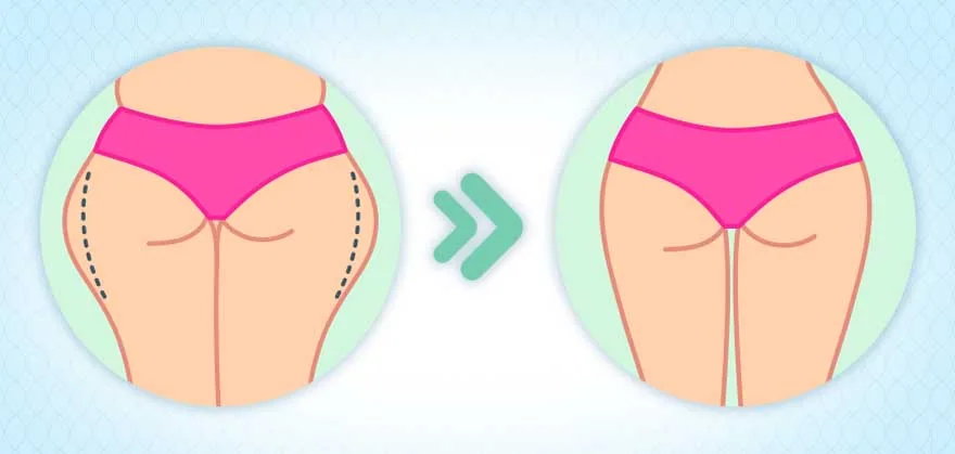 تجربتي مع العضلة النائمة وكيف تخلصت من الخفسة نهائيًا