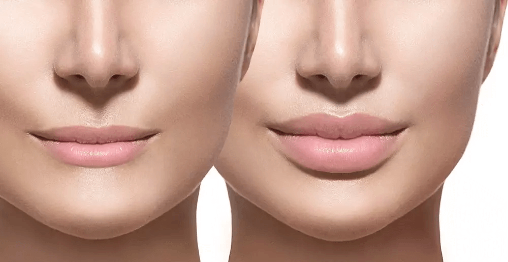 أفضل أنواع فيلر الشفايف للحصول على نتائج طبيعية