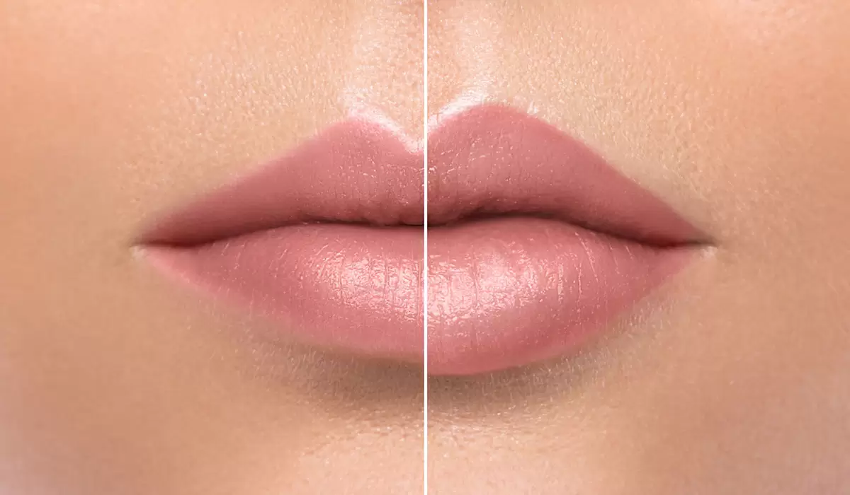 افضل انواع الفيلر للشفايف